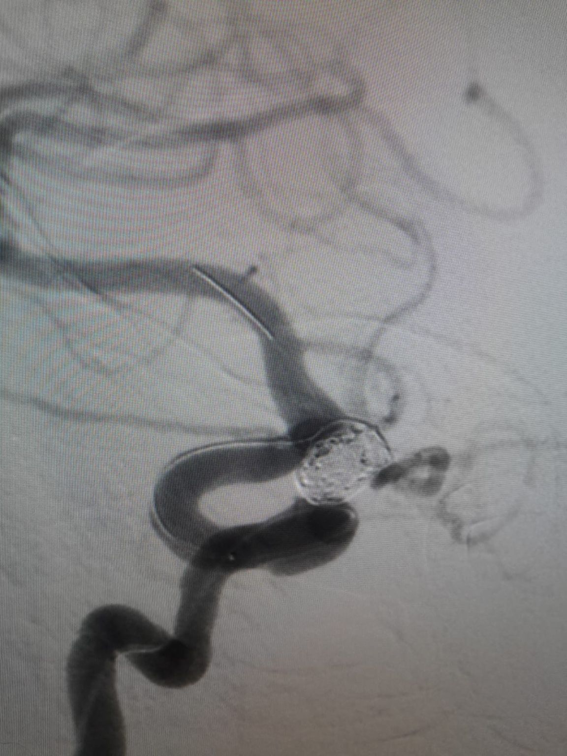 Clinical Spotlight | Nuva® Flow Diverter for Recurrent Aneurysm Management