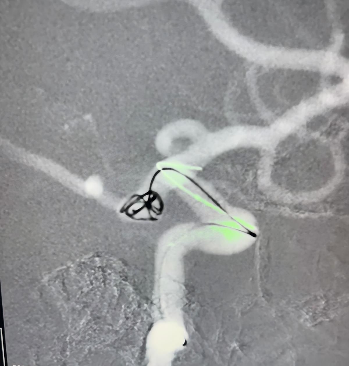 Clinical Spotlight | Nuva Flow Diverter in the Treatment of a Posterior Communicating Artery Aneurysm
