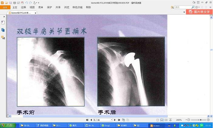 Shoulder Replacement Implant